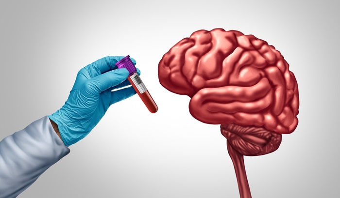 Image: The new blood test for Alzheimer’s could change how the disease is detected and diagnosed (Photo courtesy of Shutterstock)